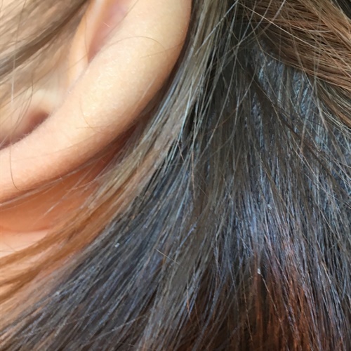 Nervoza u kosi - dosadna uš